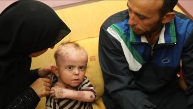 طفل سوري مصاب بالفقاع