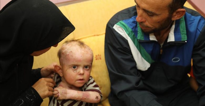 طفل سوري مصاب بالفقاع